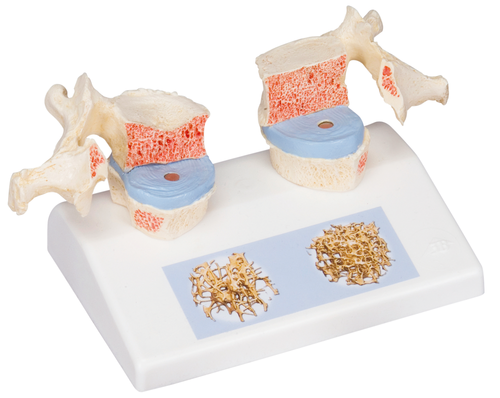 骨粗鬆症 比較モデル